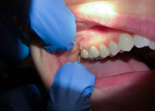 Best Emergency Dental Care for Broken or Chipped Teeth in Ironton, OH